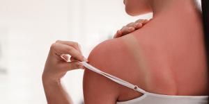 Alergie na slunce: Jak pečovat o pokožku v letním období?